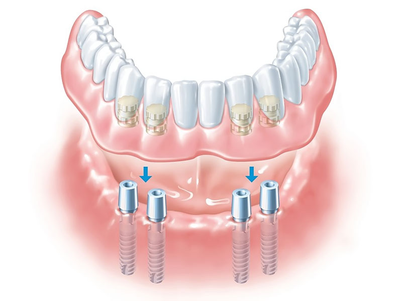 Немедленная нагрузка – новое слово в имплантации зубных протезов
